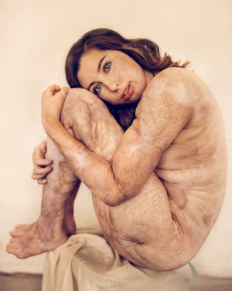 Portrait of a Burn Survivor by Sujata Seita